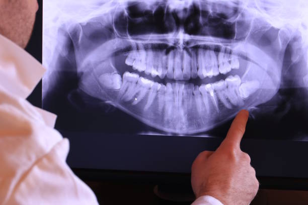 Best Knocked-Out Tooth (Avulsed Tooth) Treatment in Plymouth Meeting, PA